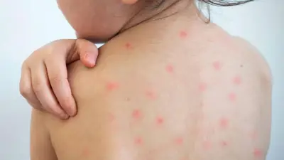 দেশে হামে আরো ৪ শিশুর মৃত্যু, আক্রান্ত ৬৮৫ জন; পাকিস্তানি বন্দরে যান চলাচল বেড়েছে