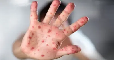 গত ২৪ ঘণ্টায় হামে আক্রান্ত হয়ে ৪ জনের মৃত্যু, নতুন আক্রান্ত ৬৮৫