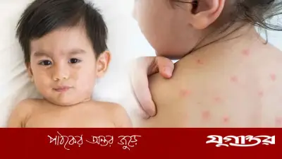 শিশুর হাম ও চিকেন পক্সে পুষ্টিকর খাবার: যা রাখবেন খাদ্যতালিকায়