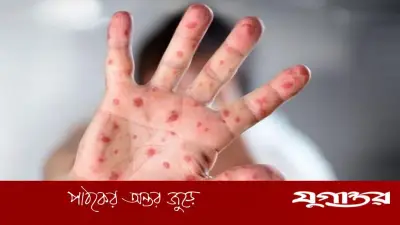 সিলেটে হামের প্রাদুর্ভাব: একদিনে ৩৪ শিশু ভর্তি, মোট আক্রান্ত ১০৫