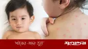 শিশুর হাম ও চিকেন পক্সে পুষ্টিকর খাবার: যা রাখবেন খাদ্যতালিকায়