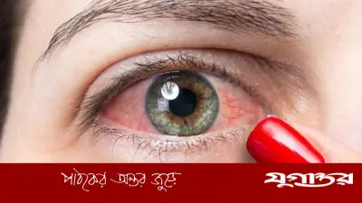 গোসলের সময় কনট্যাক্ট লেন্স না খুললে অন্ধ হওয়ার ঝুঁকি