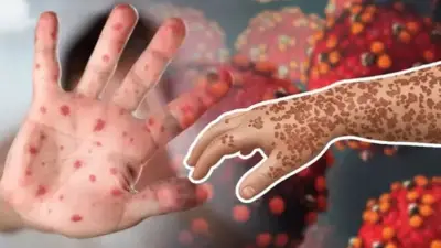 মেঘনায় সংঘর্ষে যুবক নিহত, হামে মৃত্যু ৩০০ ছাড়ালো