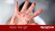 চট্টগ্রামে হামের উপসর্গে ২৪ ঘণ্টায় হাসপাতালে ভর্তি ৩৯ শিশু