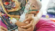 হামের প্রাদুর্ভাবে শিশুদের মৃত্যু বাড়ছে, স্বাস্থ্যব্যবস্থায় সংকট