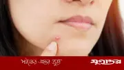 ব্রণ সমস্যার কারণ ও সমাধান: বিশেষজ্ঞদের পরামর্শ