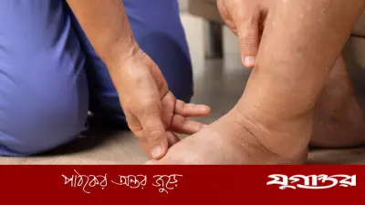 শরীরে পানি জমার কারণ ও সতর্কতা: ইডিমা সম্পর্কে বিস্তারিত