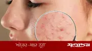 মুখে ব্রণের সমস্যা দূর করতে ঘরোয়া উপায়
