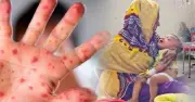 হামে আক্রান্তের সংখ্যা কমছে না, টিকার কাভারেজ নিয়ে উদ্বেগ
