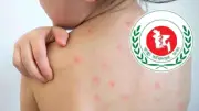 হাম ও উপসর্গে ২৪ ঘণ্টায় আরও চার শিশুর মৃত্যু, প্রধানমন্ত্রীর উপদেষ্টাকে দিল্লিতে বাধা