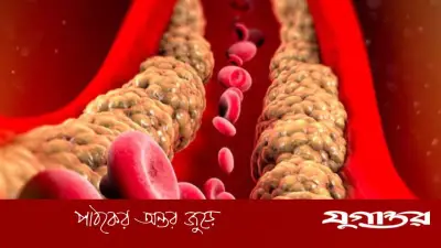 কোলেস্টেরল সামান্য বেশি হলে কী করবেন? বিশেষজ্ঞদের পরামর্শ